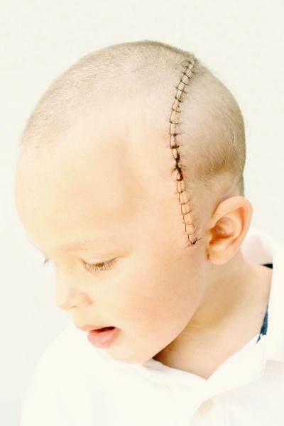 Cole-surgery recover