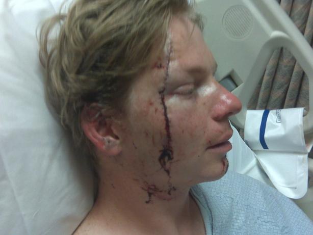 The worst of Mike's lacerations was on his face-narrowly missing an eye and his carotid artery